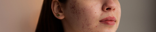 Skin Cycling: Can It Help Reduce Breakouts and Skin Damage?