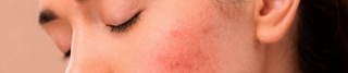 Skin Purging vs Breakout: How to Tell What Your Skin Is Going Through